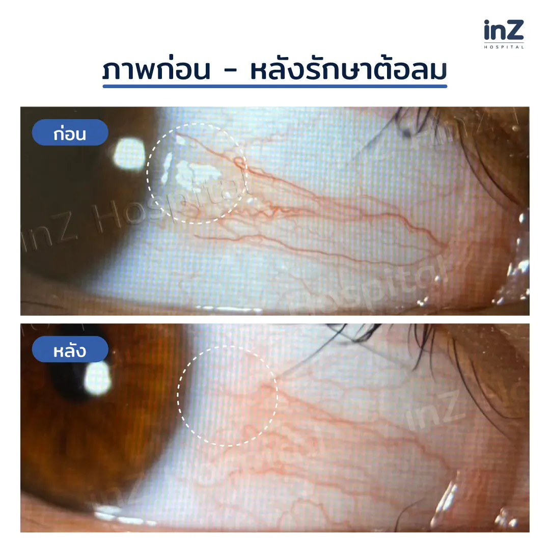 ภาพก่อนหลังผ่าตัดต้อลมที่ตา