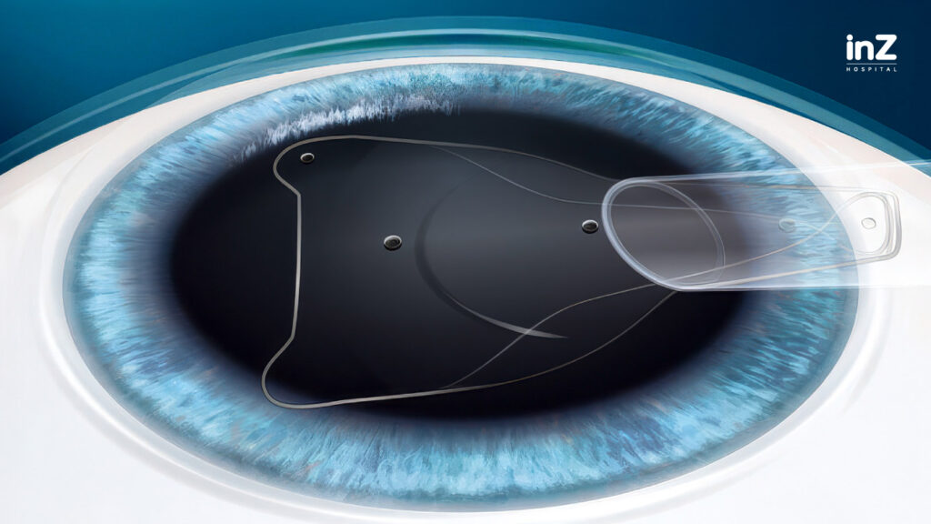 ใส่เลนส์เสริม ICL
