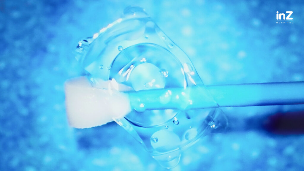 Implantable Collamer Lens (ICL)