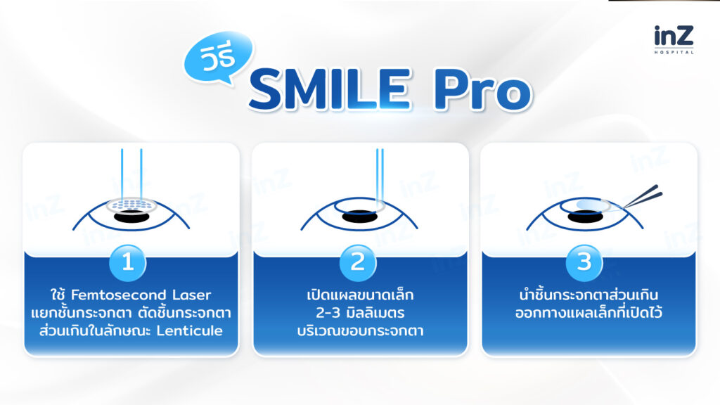 ขั้นตอนการทำ SMILE Pro