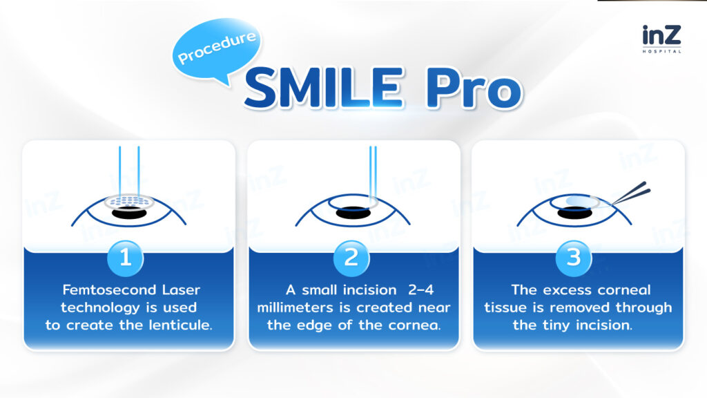 SMILE Pro Procedure Steps