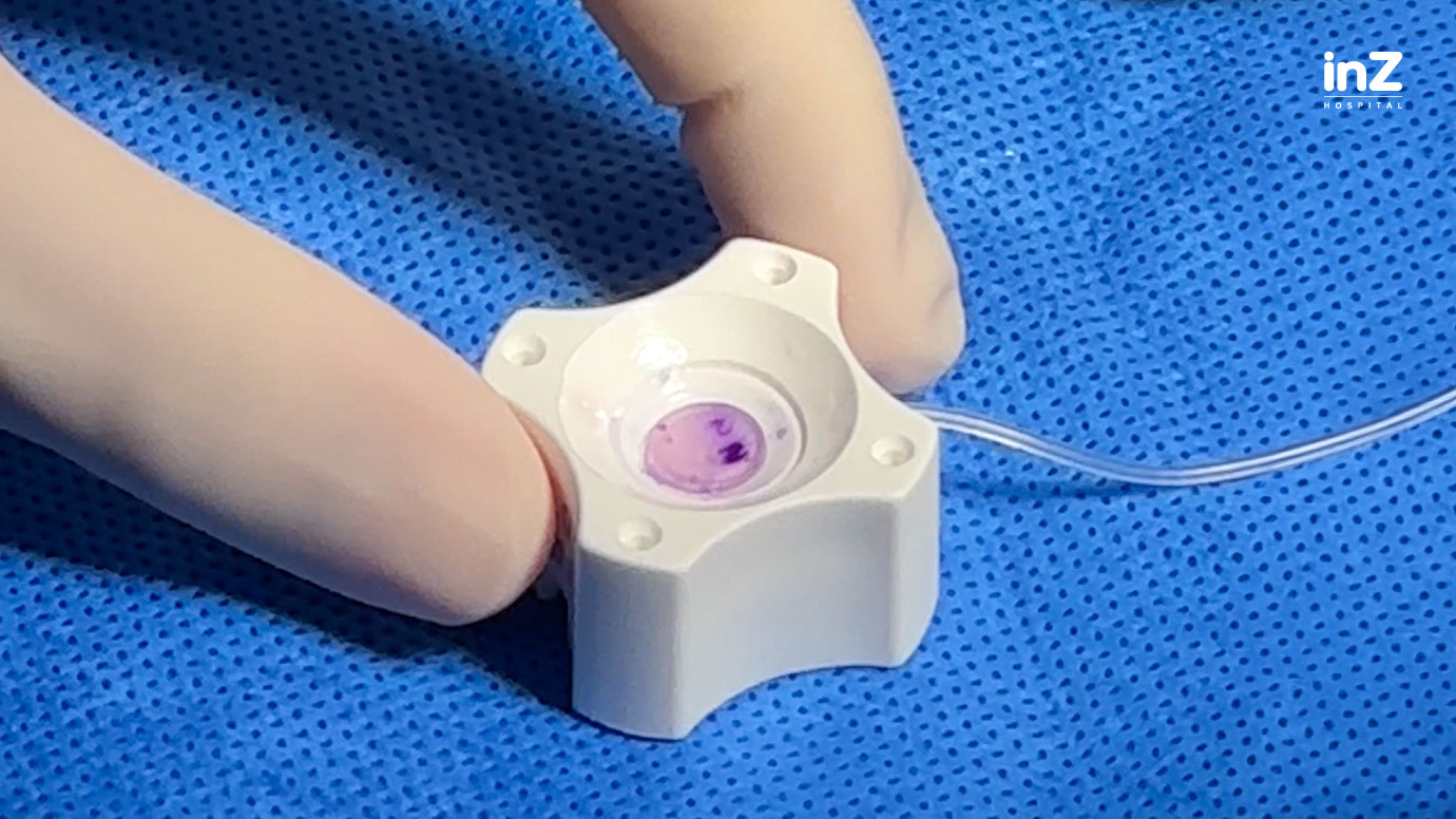 cornea implant
