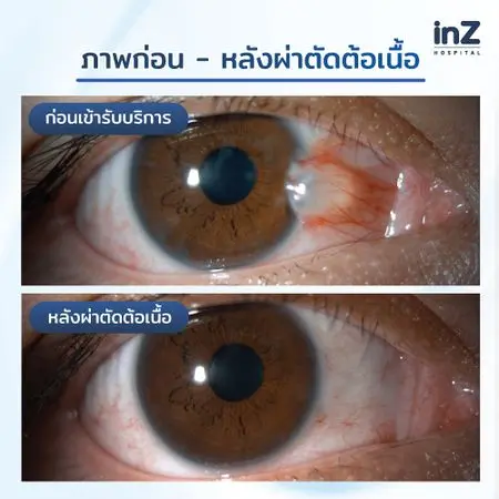 การรักษาต้อเนื้อ